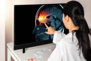 Titusville Traumatic Brain Injury Lawyer